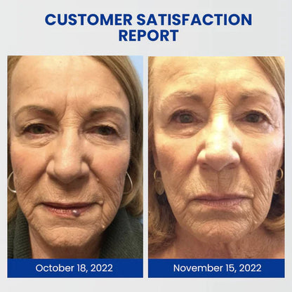Kasperfect TM WartsOff Instant Blemish Removal Cream