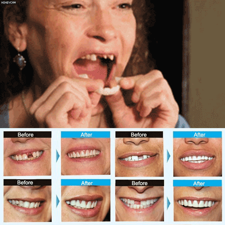 Silicone Reline Denture Set