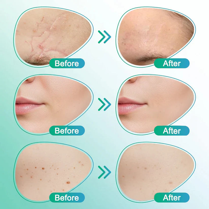 ✨ LAST DAY BUY 1 GET 1 FREE✨CareBreeze® 3-in-1 Microneedle Care Patch