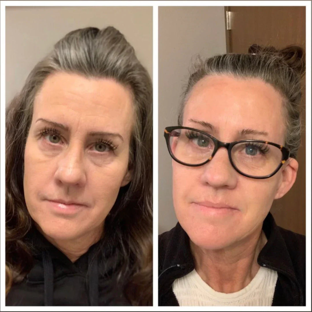 🔥🔥HOT SALE - ✨Forehead &amp; Between Eyes Wrinkle Patches