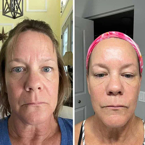 🔥🔥HOT SALE - ✨Forehead &amp; Between Eyes Wrinkle Patches