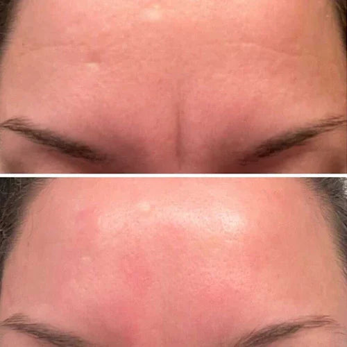🔥🔥HOT SALE - ✨Forehead &amp; Between Eyes Wrinkle Patches