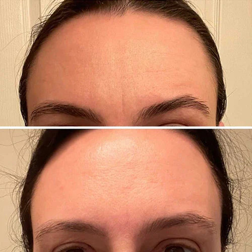🔥🔥HOT SALE - ✨Forehead &amp; Between Eyes Wrinkle Patches